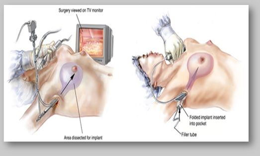 Breast Implant Surgery
