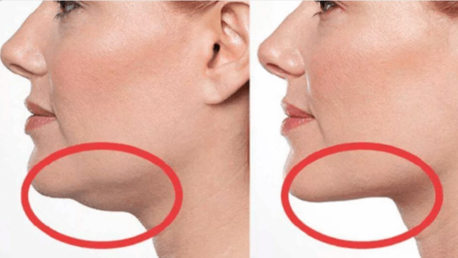Double Chin Liposuction
