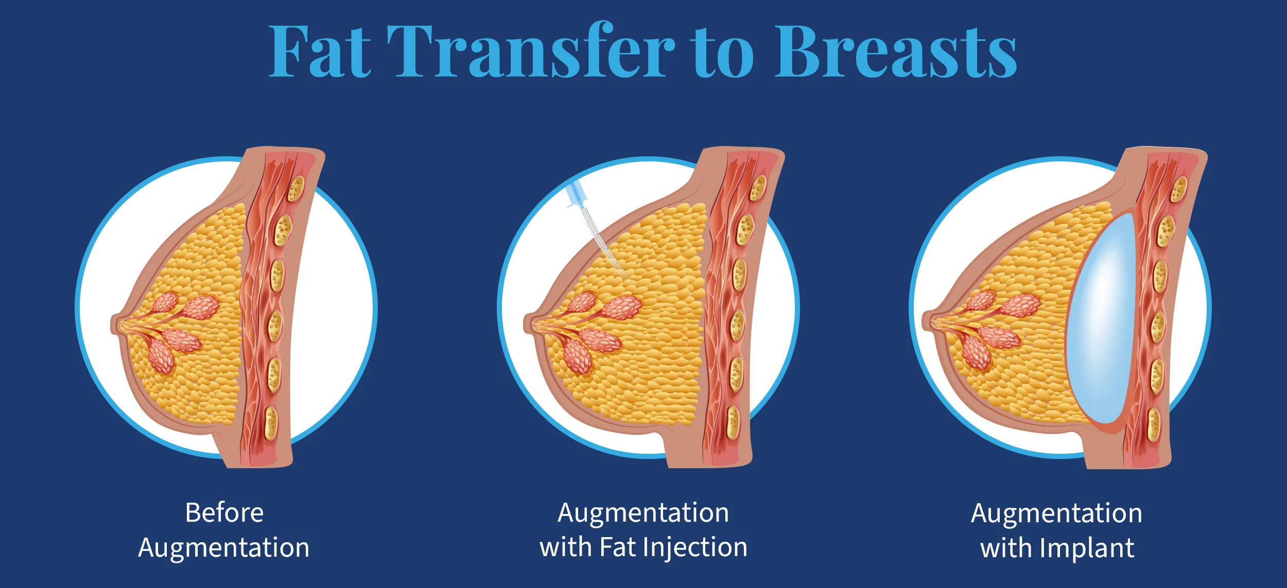 Fat Transfer Breast Enhancement