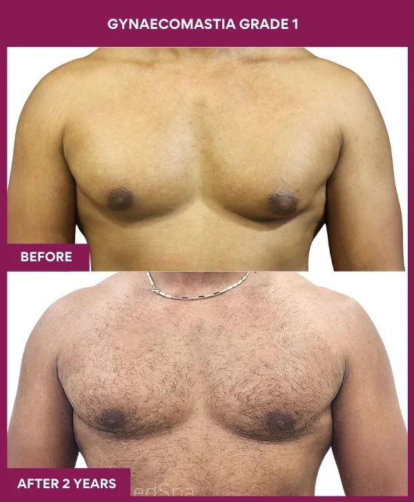 Grade I Gynaecomastia