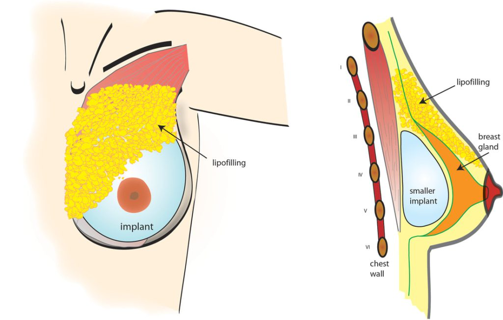 Hybrid Breast Augmentation