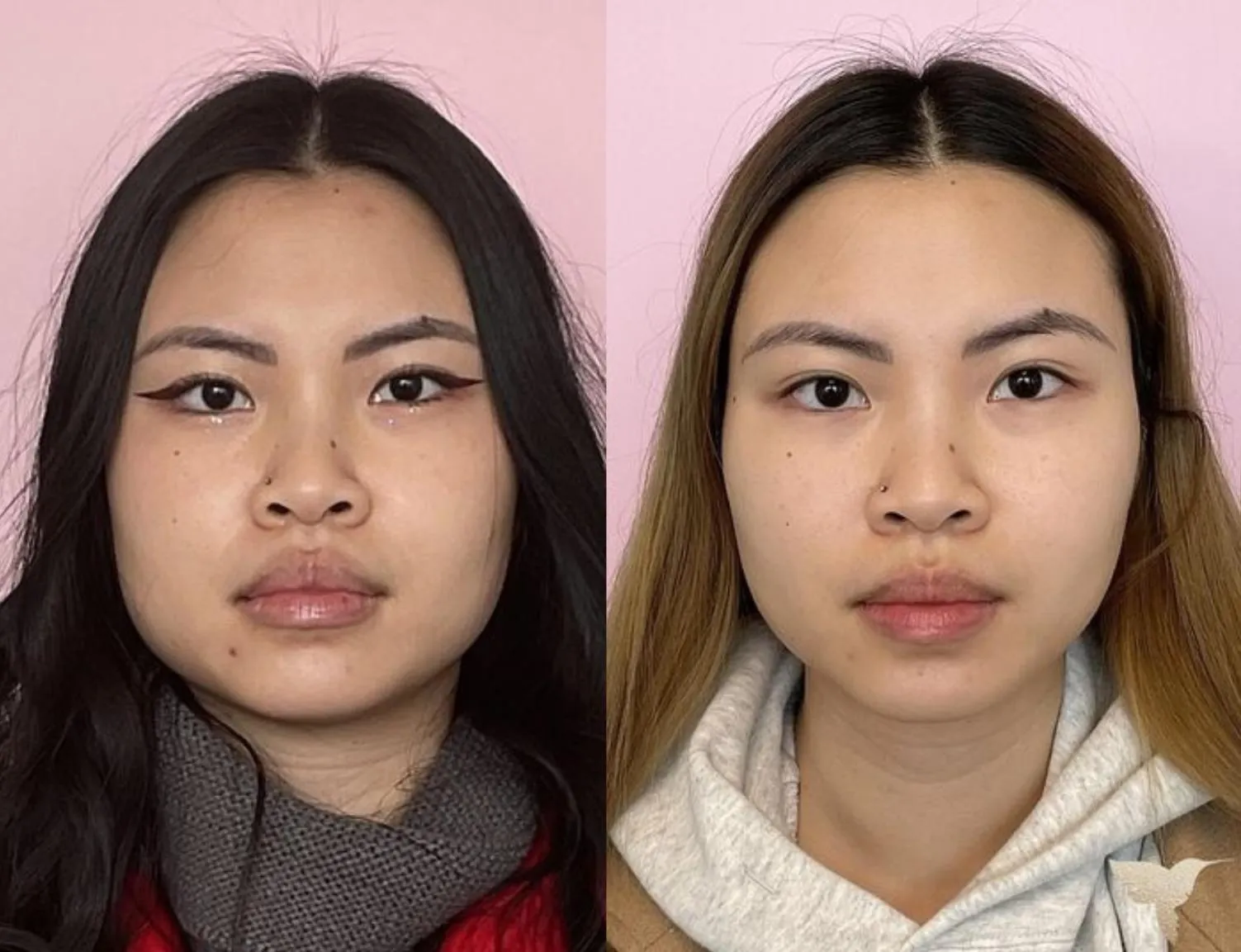 Jaw Slimming Injections