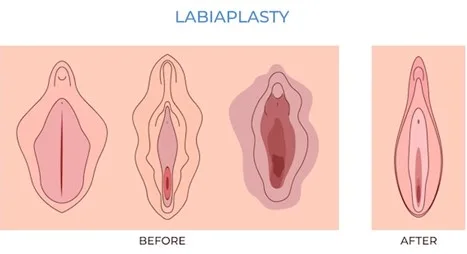 Labiaplasty