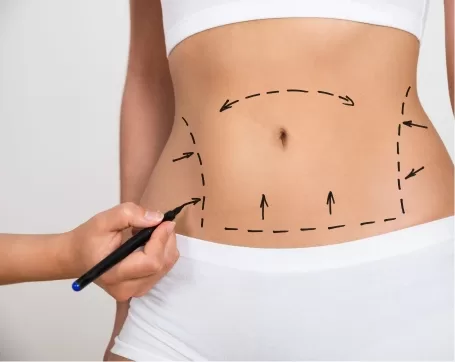 Abdomen and Waist Liposuction