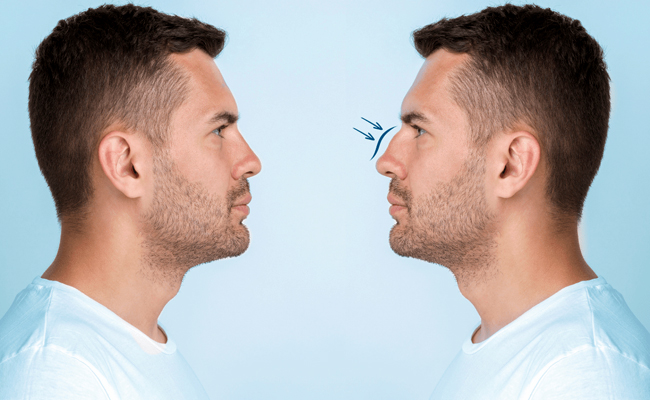 Male Rhinoplasty