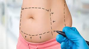 Mini Tummy Tuck