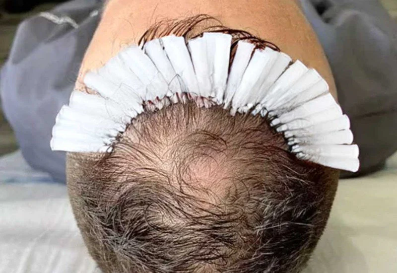 PDO Threads for Hair Support