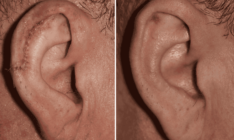 Prominent Ear Correction