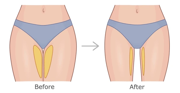 Thigh Enhancement